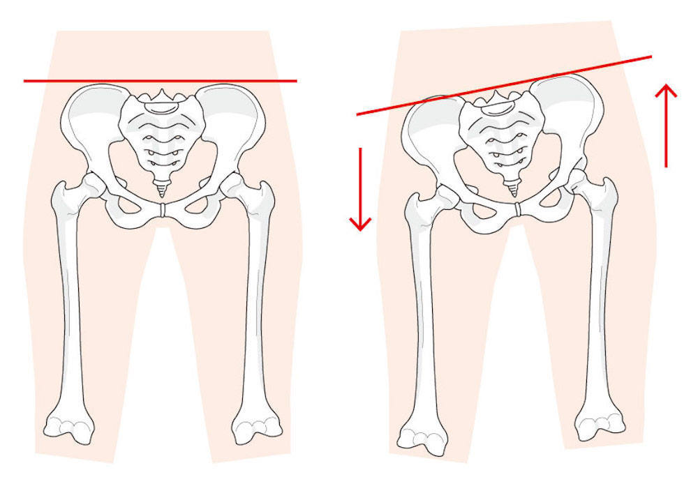 左図は正常。右の図は筋肉（腰方形筋）に引っ張られ骨盤が傾いています。