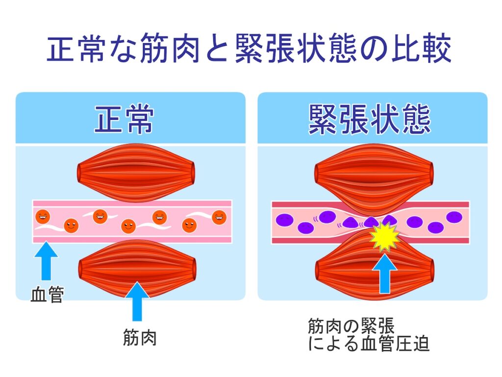 筋肉の緊張　血行不良